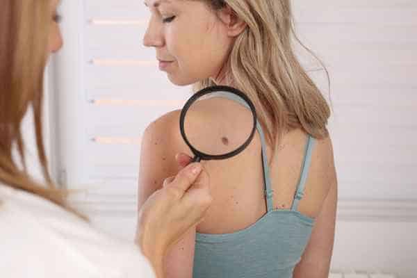 What Are Traditional Skin Lesion Removal Methods Bexley?