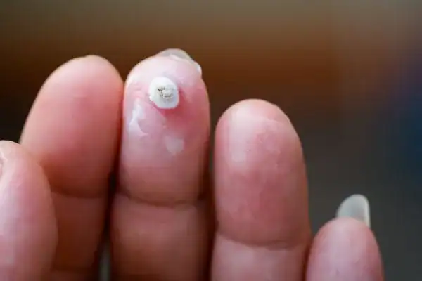 Image of white wart before cryopen treatment Bexley
