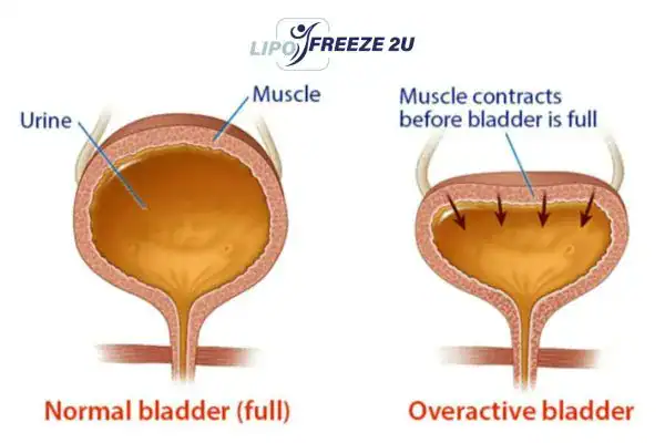 diagram of overactive bladder treatment Bexley