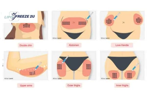 Benefits of Choosing Aqualyx for Fat Reduction Bexley