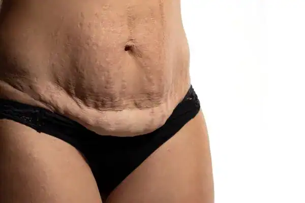 loose skin after weight loss injections Bexley