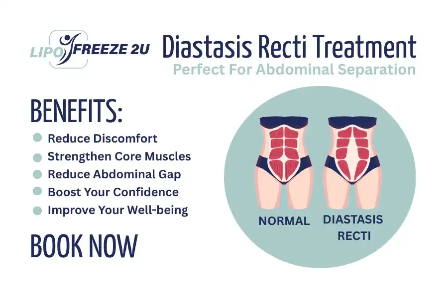 Benefits of body toning treatment Bexley for Diastasis recti