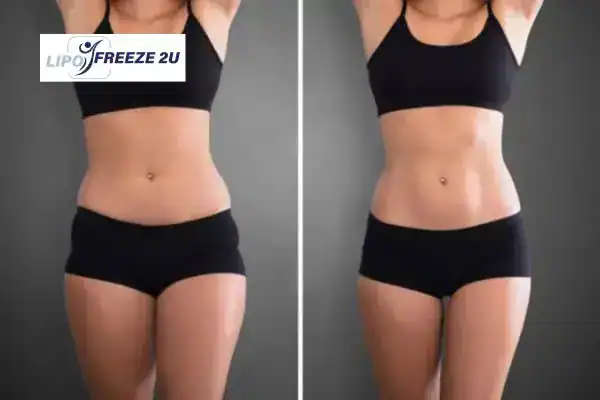 How Can LIPO FREEZE 2U Support Your Post-Pregnancy Body Recovery Bexley?
