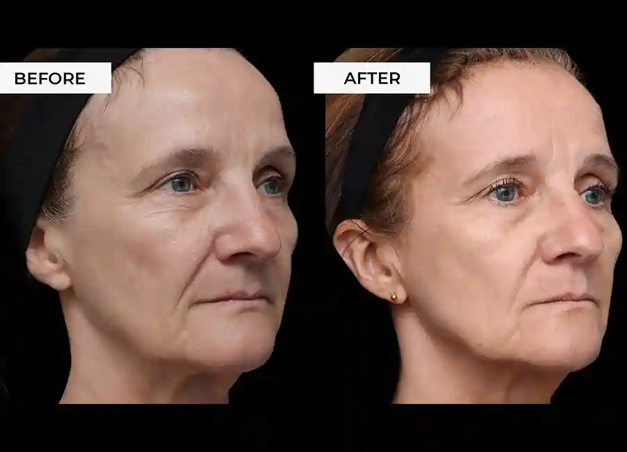 How Many RF Microneedling Sessions Will You Need to See a Difference Bexley?
