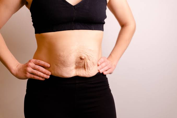Is Surgery Really the Only Way to Repair Diastasis Recti Bexley?
