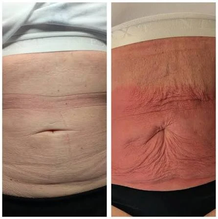 How Does RF Microneedling Improve Crepey, Thin and Uneven Skin Texture Bexley?