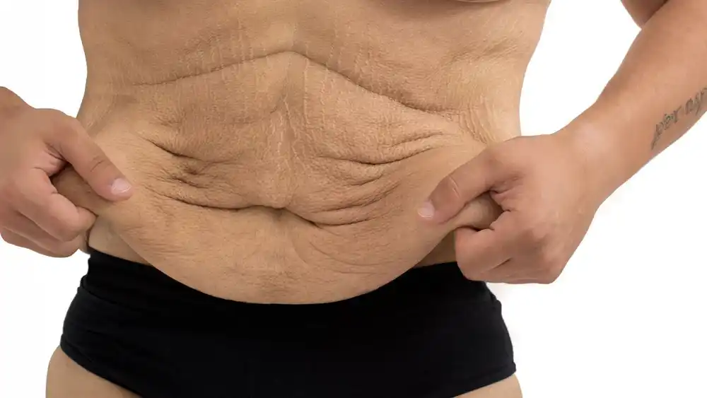 RF Microneedling for Loose Skin: How Can It Help Tighten and Reshape the Skin Bexley?